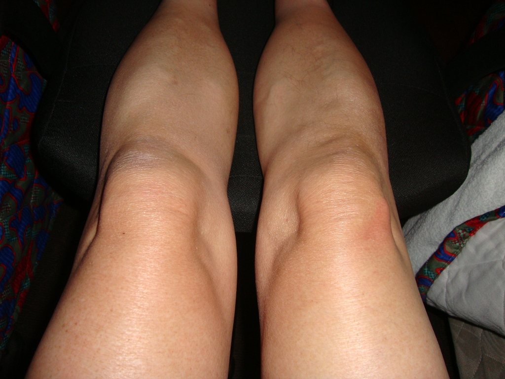 I can't see any difference, but the right one hurts and the left one doesn't.