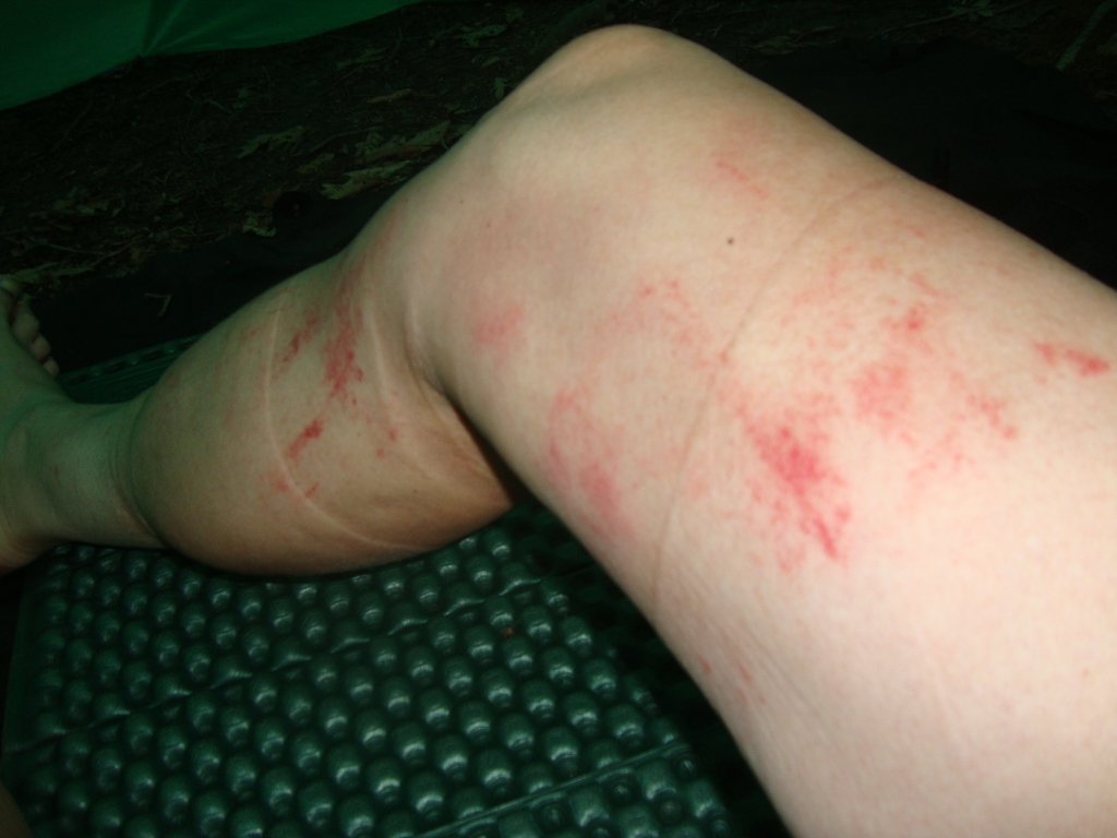 After discovering this Wednesday morning, I wrapped my old elastic-free Ace bandage around the right leg before applying the knee brace. It worked great! 7:10 AM, Rich Mountain campsite.